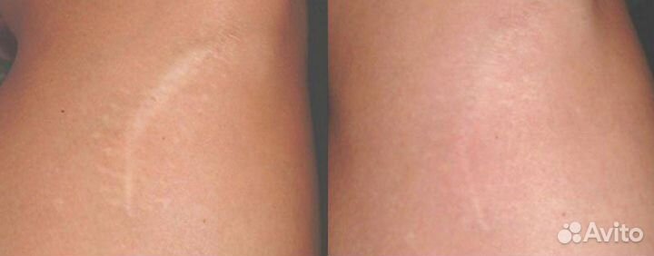 Камуфляж рубцов и шрамов,витилиго