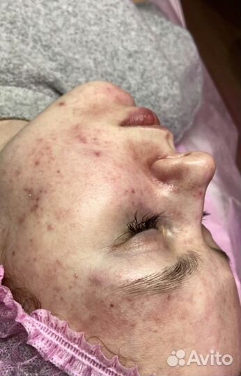 Уход / Инъекции / Лечение лица или волос