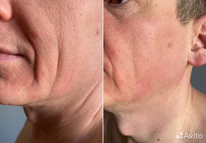 Скульптурно-буккальный массаж лица