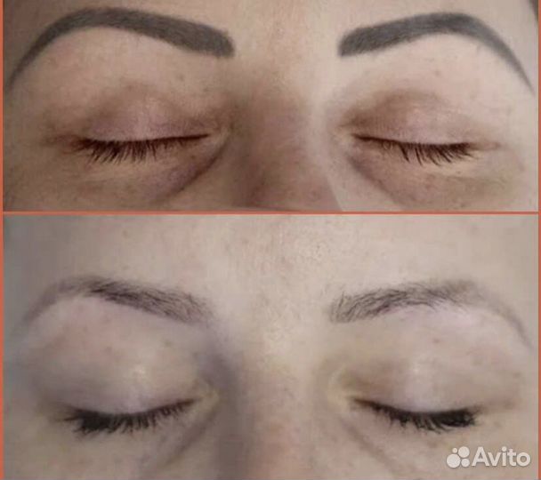 Удаление татуажа и тату