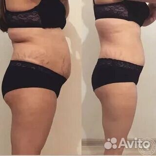 Вакуумно роликовый массаж на аппарате Starvac