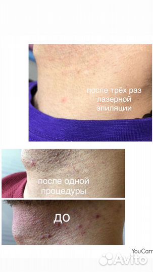 Лазерная эпиляция: глубокое бикини