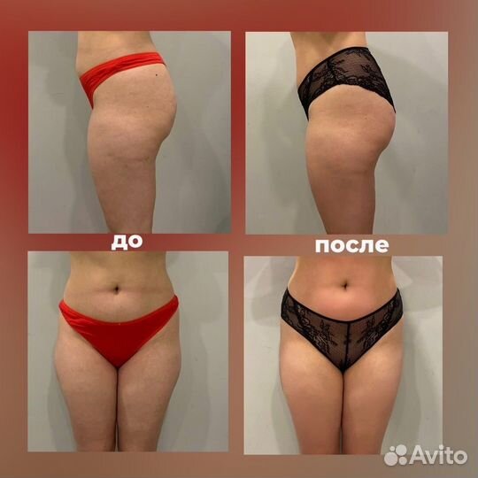 LPG массаж, RF лифтинг