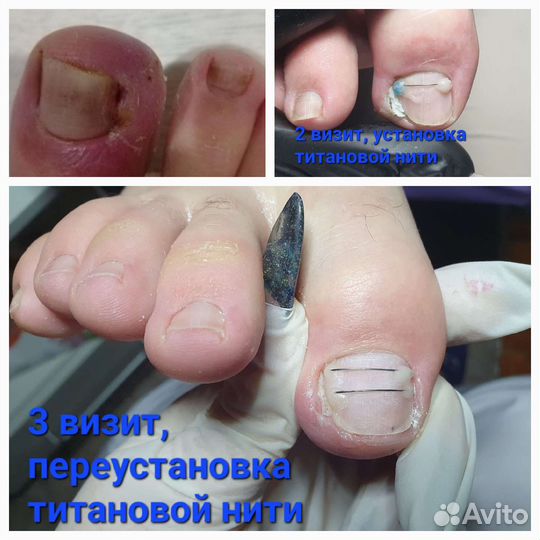 Лечение вросших ногтей