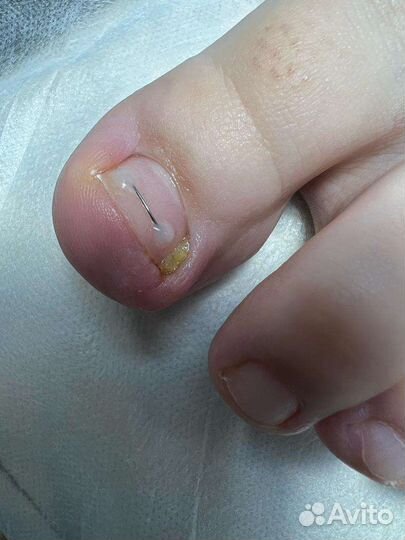 Лечение вросшего ногтя. Медицинский педикюр