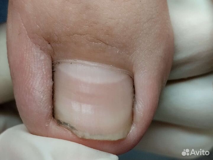 Обработка вросших ногтей и онихолизиса