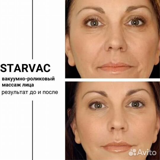 Вакуумно роликовый массаж на аппарате Starvac