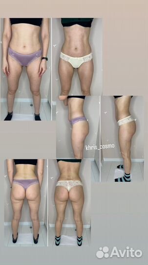 LPG массаж, микроигольчатый RF-лифтинг, кавитация