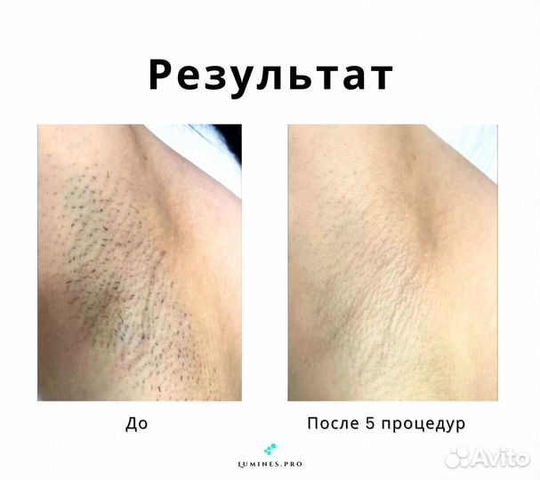 Диодный лазер для эпиляции Люминес максван 1200