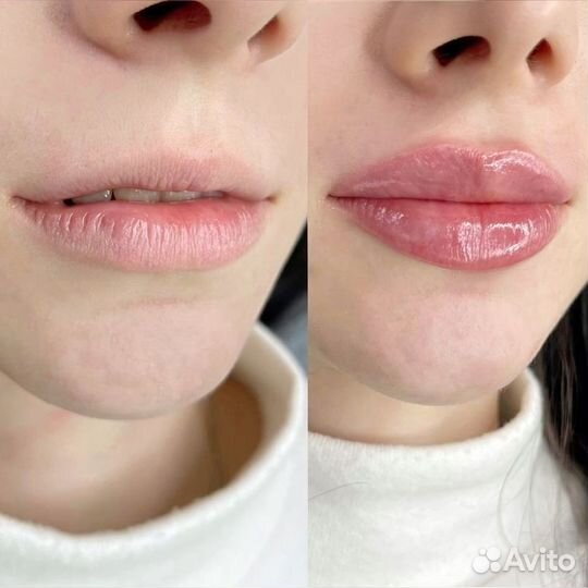 Увеличение губ. Профиль Джоли. Косметология