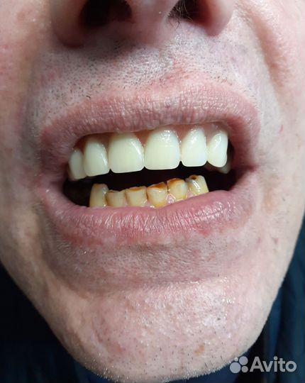 Зубной техник съемное протезирование