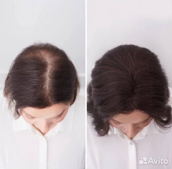 Система замещения волос при алопеции модель