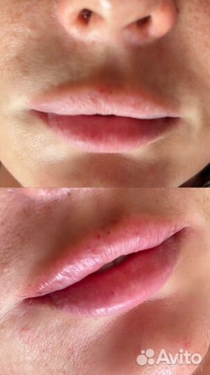 Модель на увеличение губ