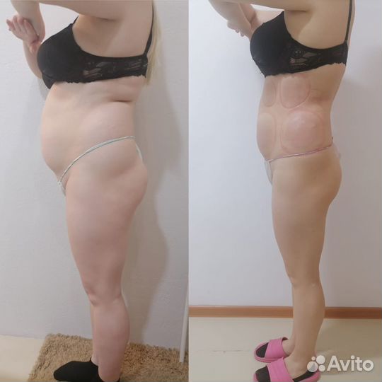 Антицеллюлитный массаж