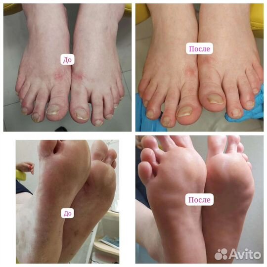 Медицинский педикюр