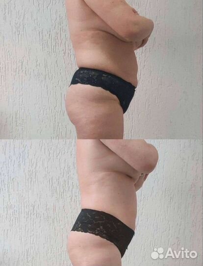 Модель на аппаратный массаж