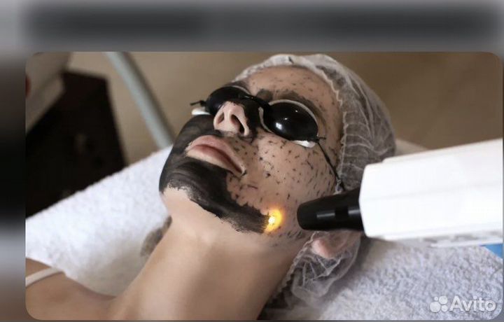 Карбоновый пилинг