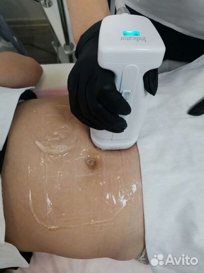 Липосоникс liposonix