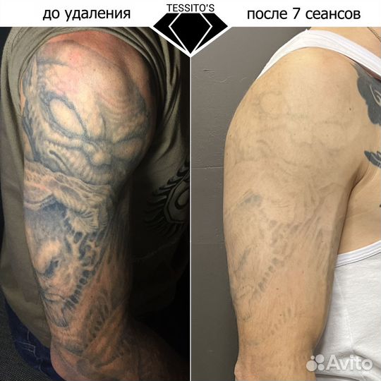 Удаление тату