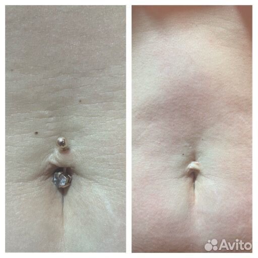 Массаж LPG на аппарате Vela Shape