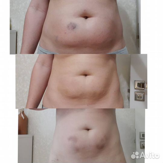 Косметолог, чистка лица, пилинг,омоложение