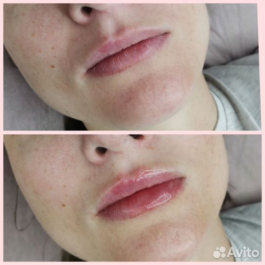Контурная пластика губ