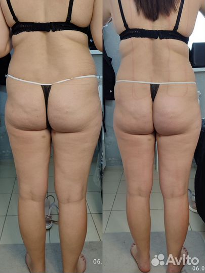 Карамельная липосакция модели