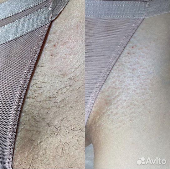 Электроэпиляция