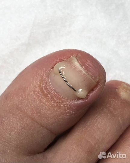 Медицинский препаратный педикюр, подолог