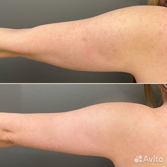 Модели на Криолиполиз Рук