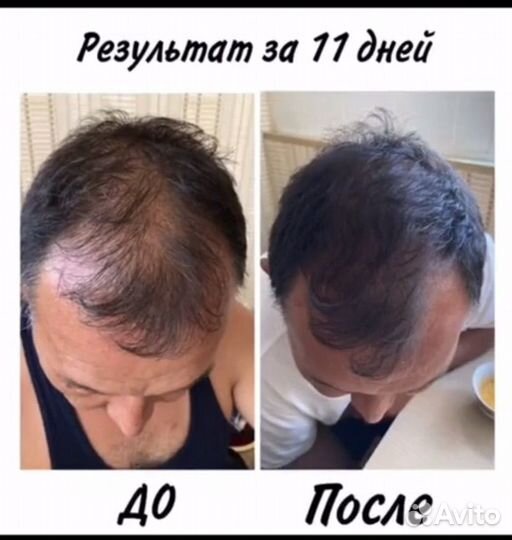 Спрей против выпадения волос Атоми