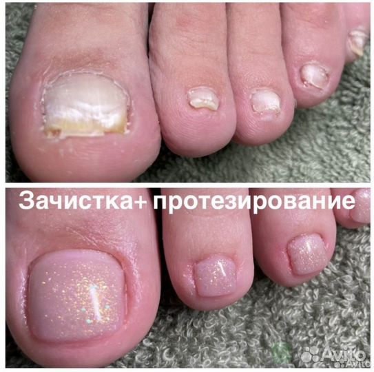 Медицинский педикюр,подолог