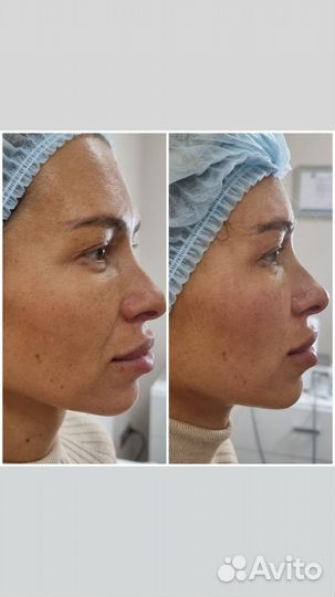 BTL Exilis бтл