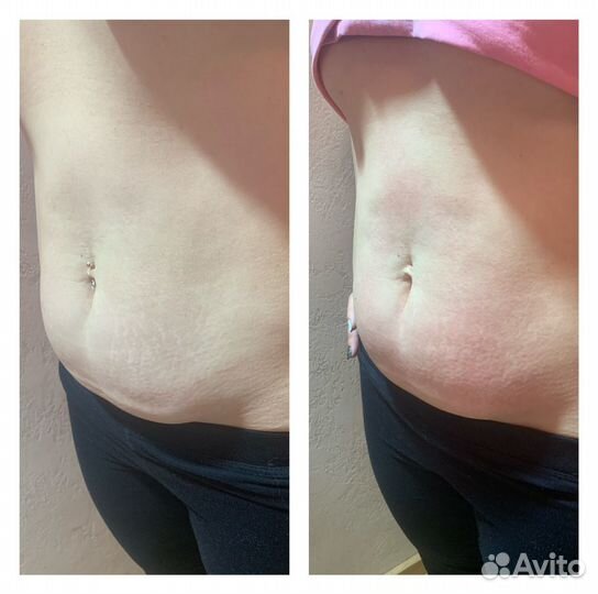 Массаж LPG на аппарате Vela Shape