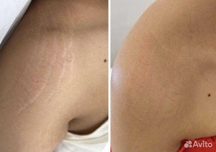 Камуфляж шрамов / рубцов (перманент )