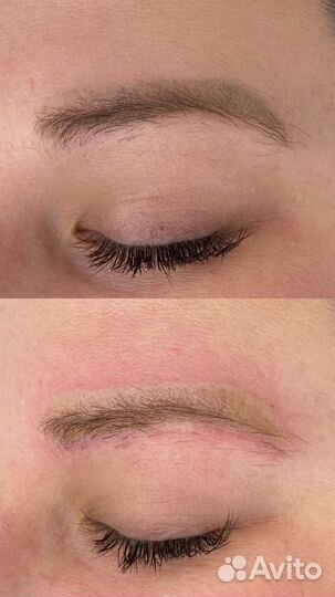 Лазерное удаление татуажа тату бесплатно