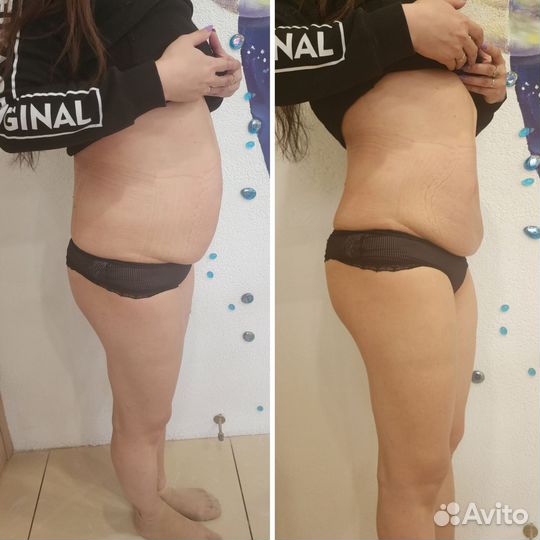 Лазерная липосакция