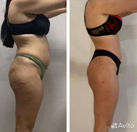 Антицеллюлитный массаж