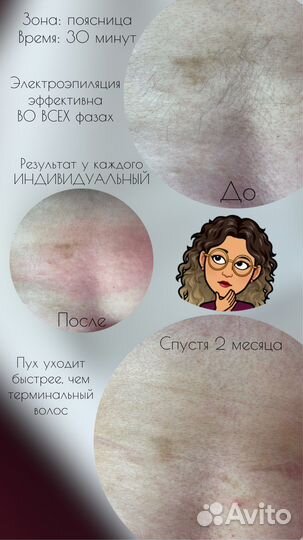 Электроэпиляция