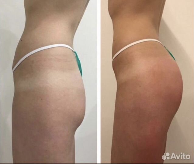 Антицеллюлитный массаж