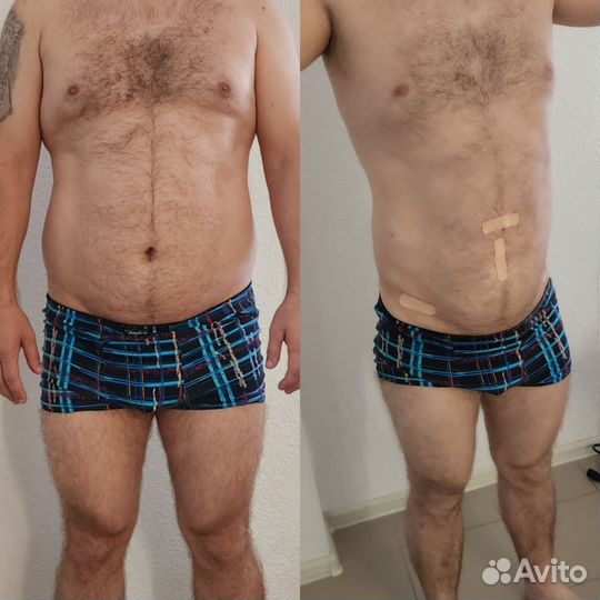 Лазерная липосакция