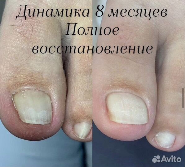 Медицинский педикюр подолог