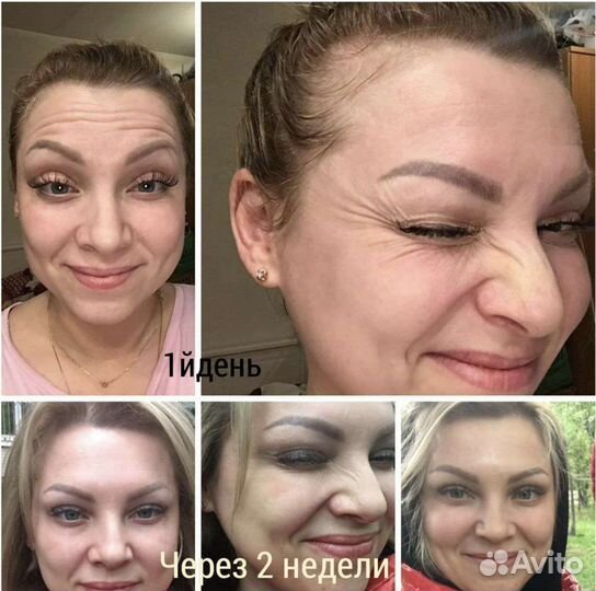 Ботокс требуются модели