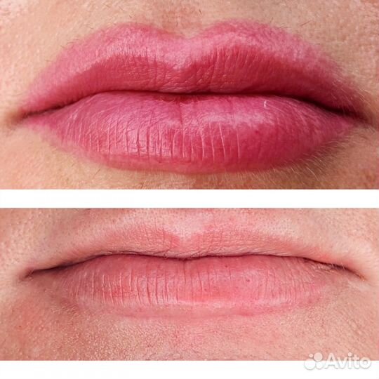 Удаление татуажа лазером