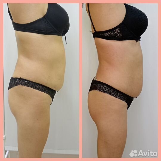 Антицеллюлитный массаж ручной