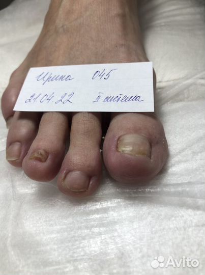 Установка титановой нити, зачистка онихолизиса