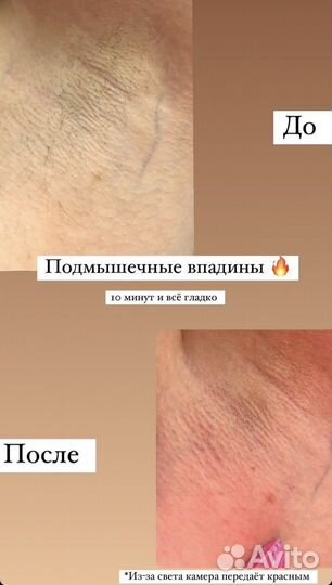 Депиляция на дому