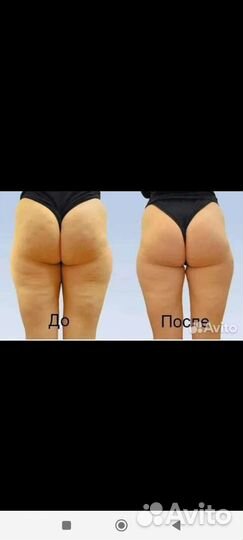 Антицеллюлитный массаж