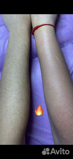 Электроэпиляция