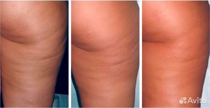 Антицеллюлитный баночный массаж / м.Петроградская